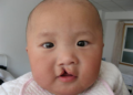 lip and palate deformity