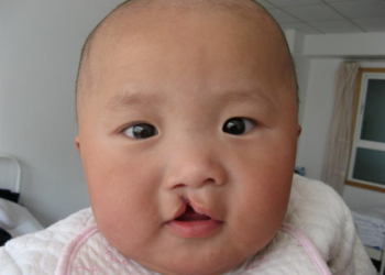 lip and palate deformity